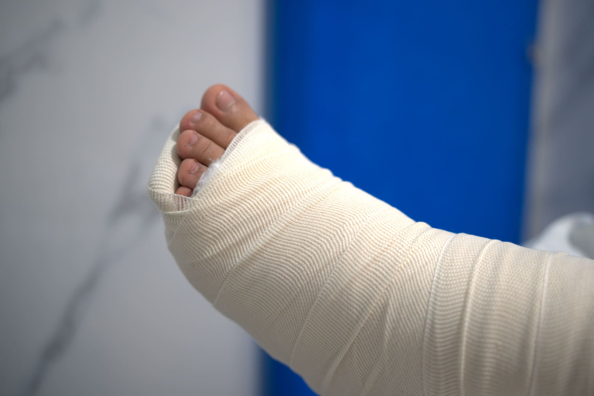 Un pie envuelto en una férula recién puesta, con los dedos descubiertos, contra el azul de una cortina de hospital.